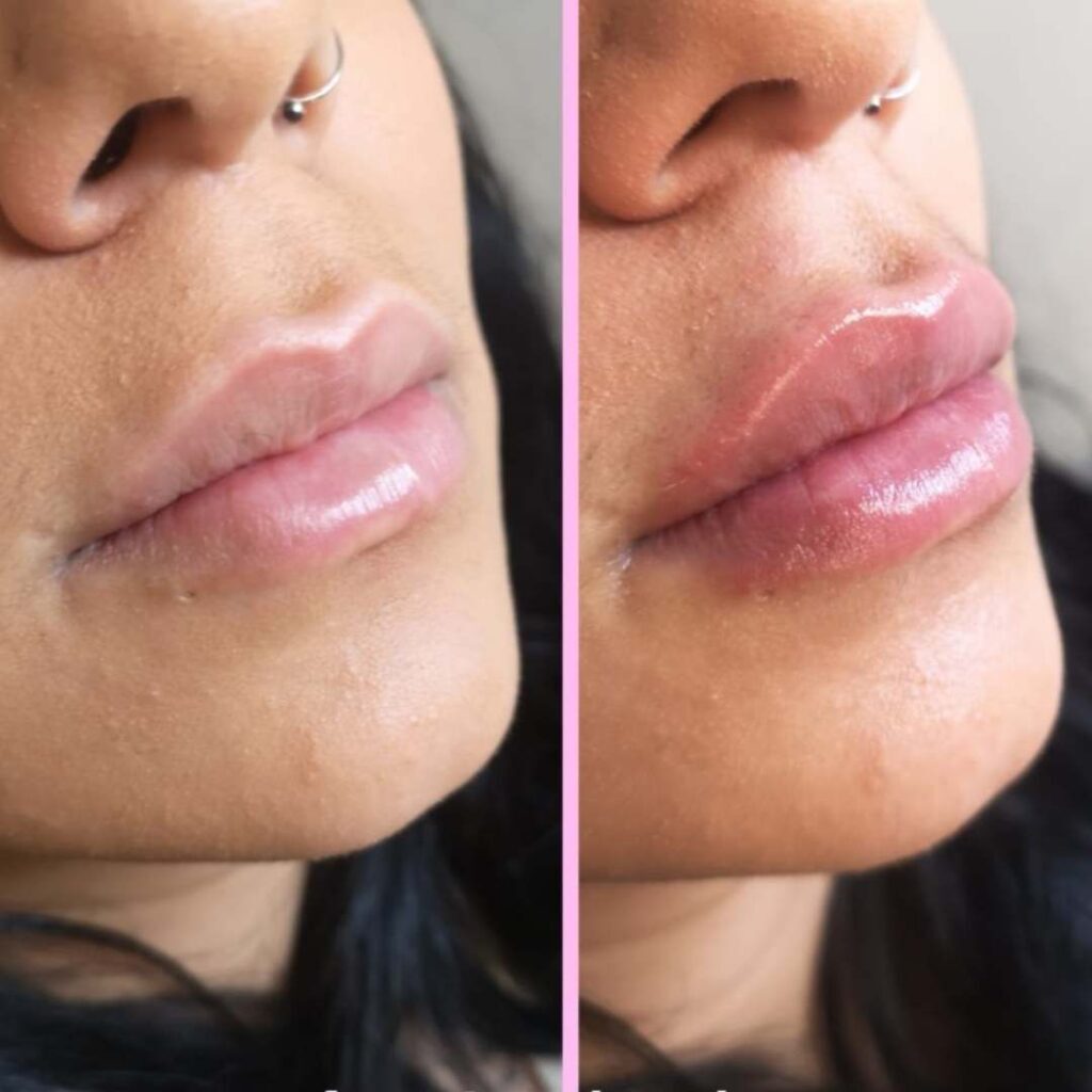 lip filler at luxury aesthetic clinic