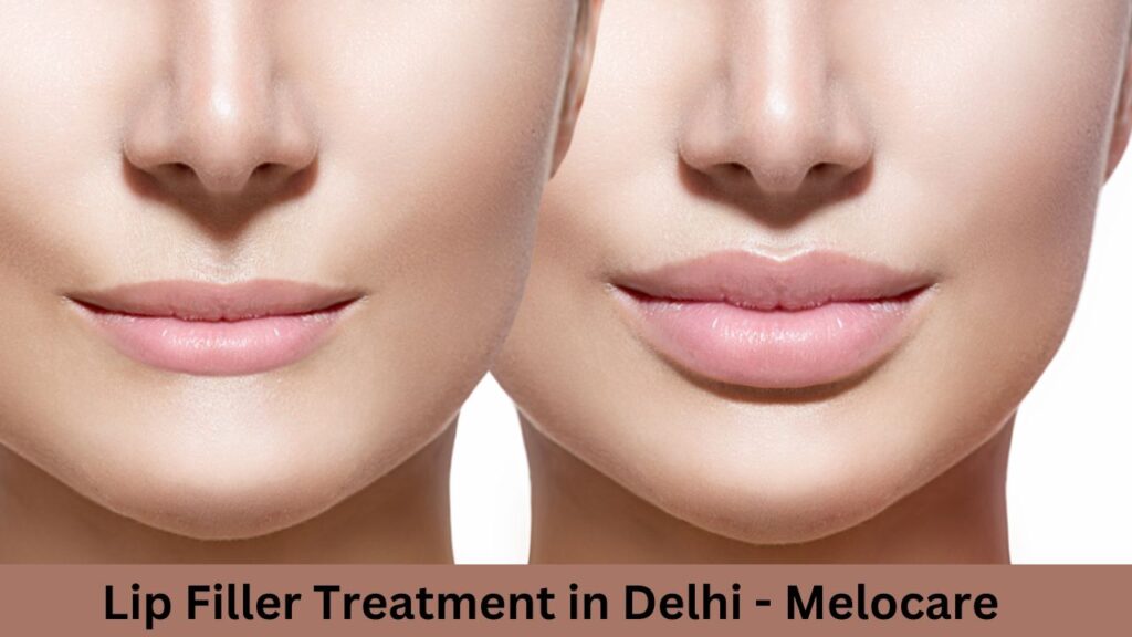 Lip Filler Treatment in Delhi
