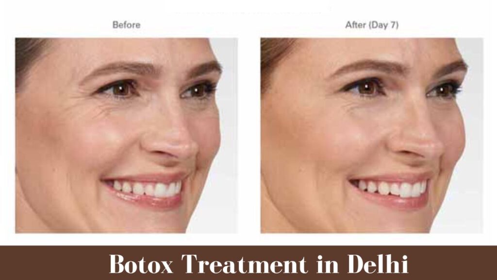 Best Botox Treatment in Delhi: Melocare