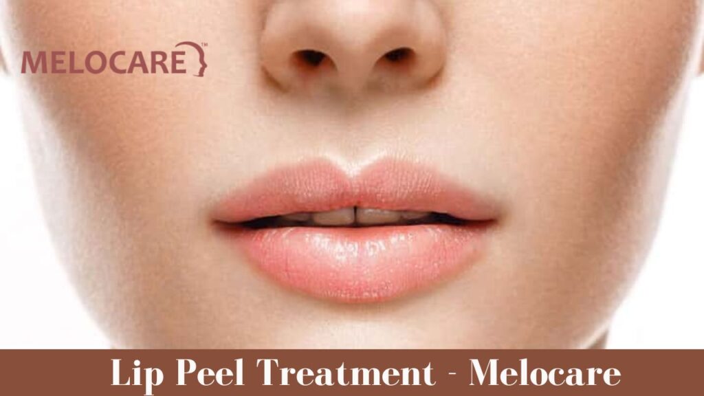 Lip Peel Treatment in Delhi | Melocare