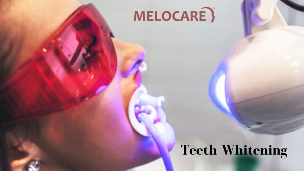 Teeth Whitening - Melocare