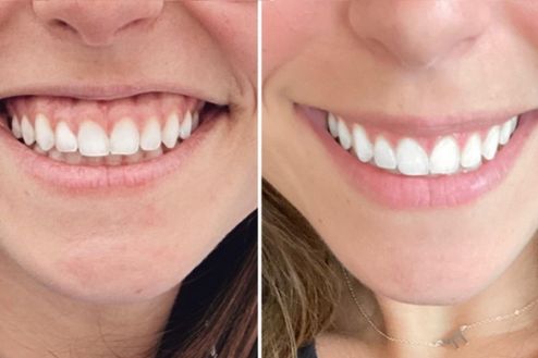 Gummy Smile Treatment With Botox