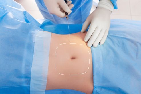 Laser Assisted Lipolysis​