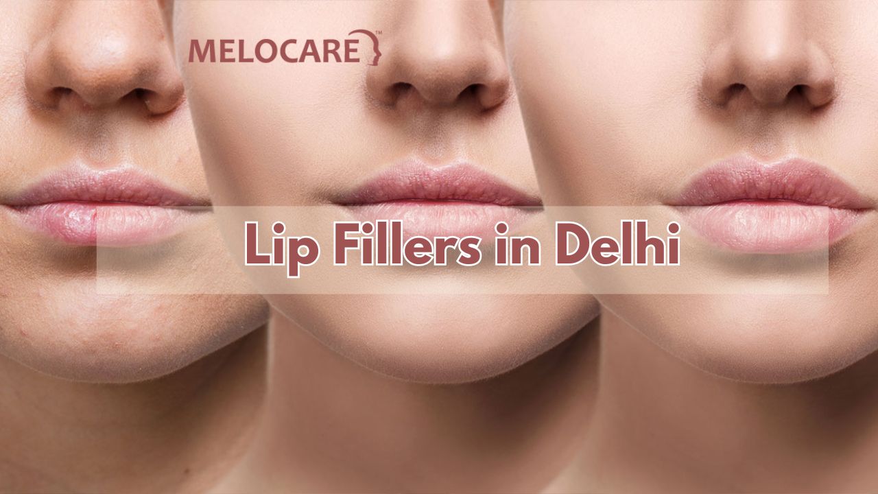 Lip Fillers in Delhi